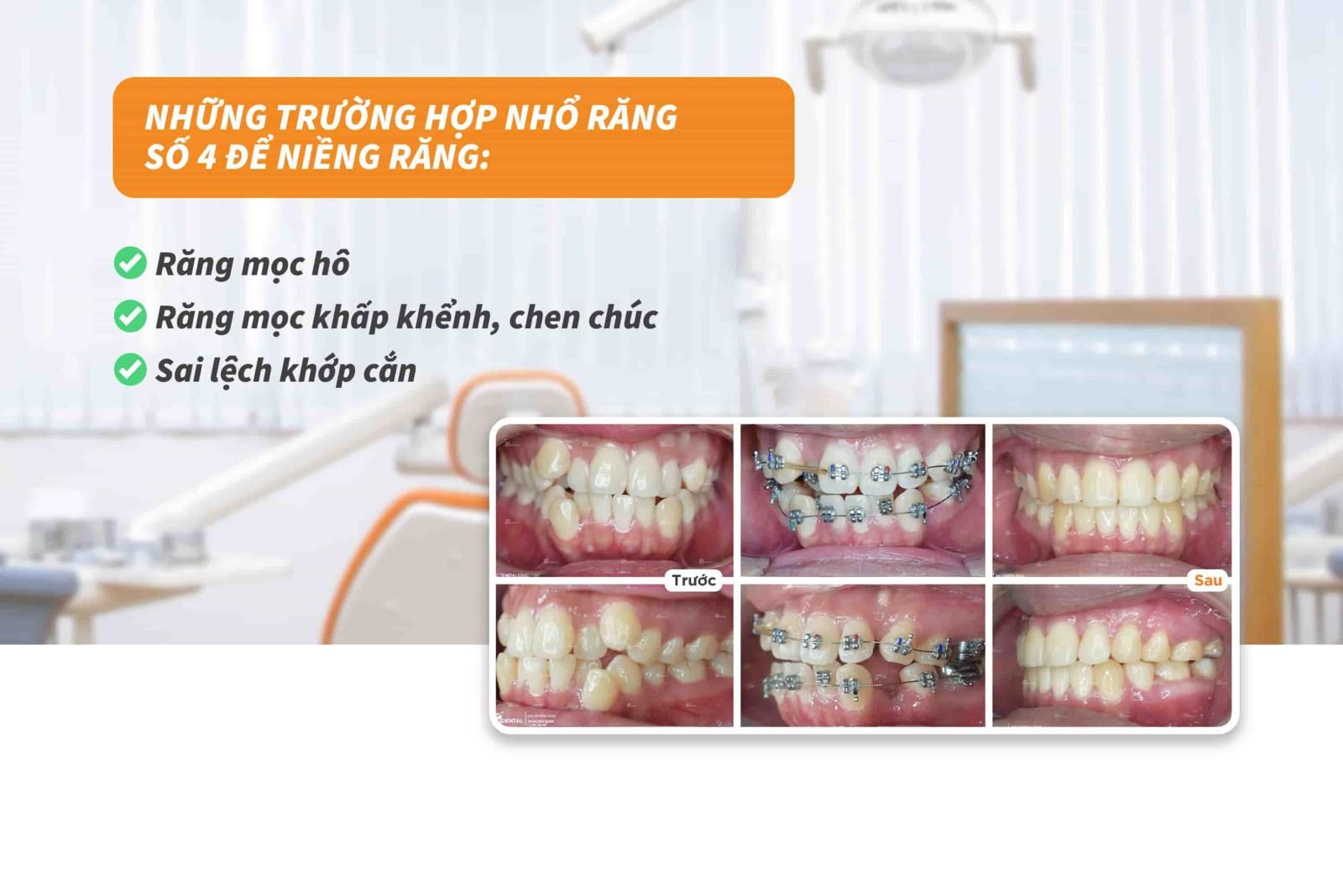 Những trường hợp nhổ răng số 4 để niềng răng