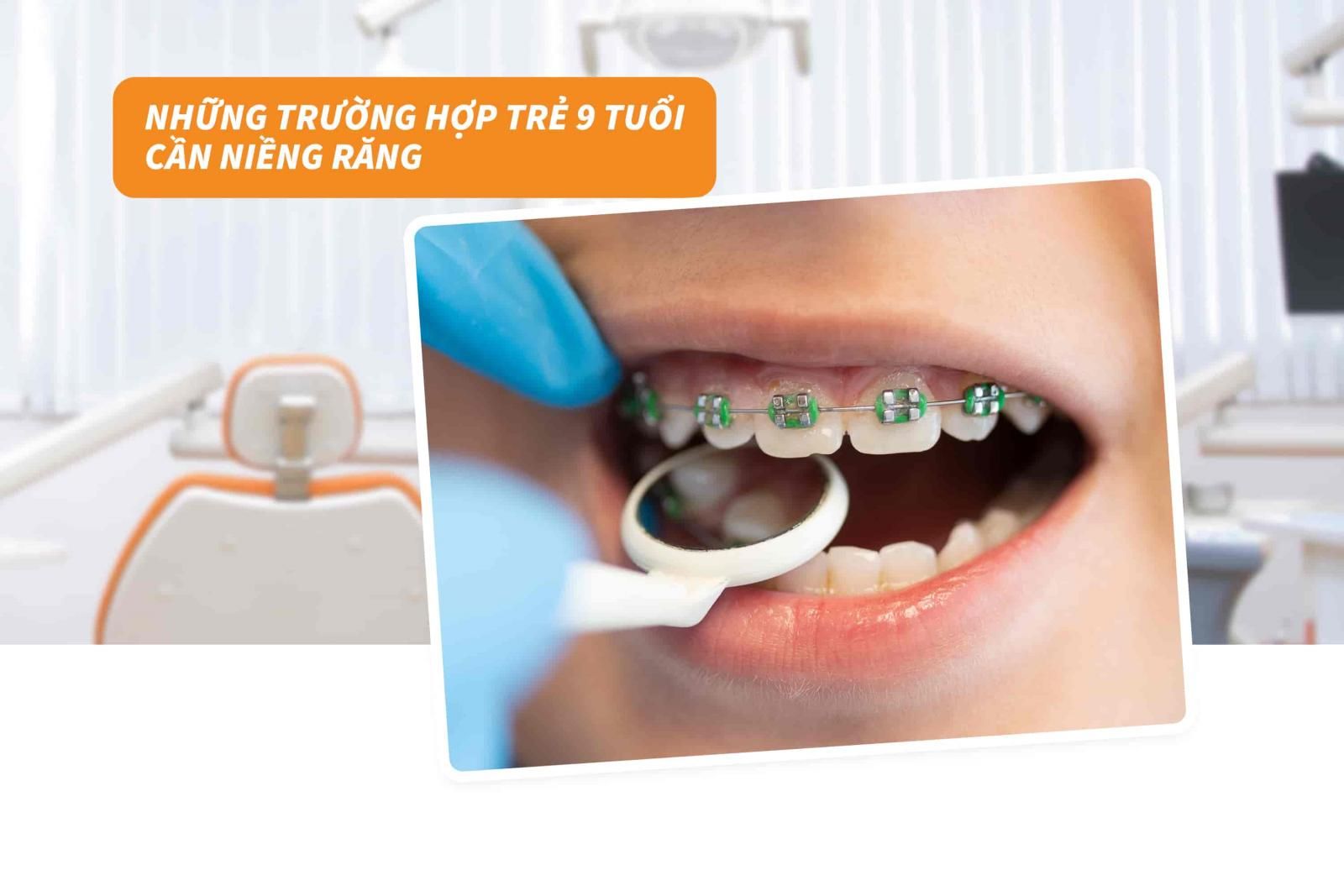 Những trường hợp trẻ 9 tuổi cần niềng răng