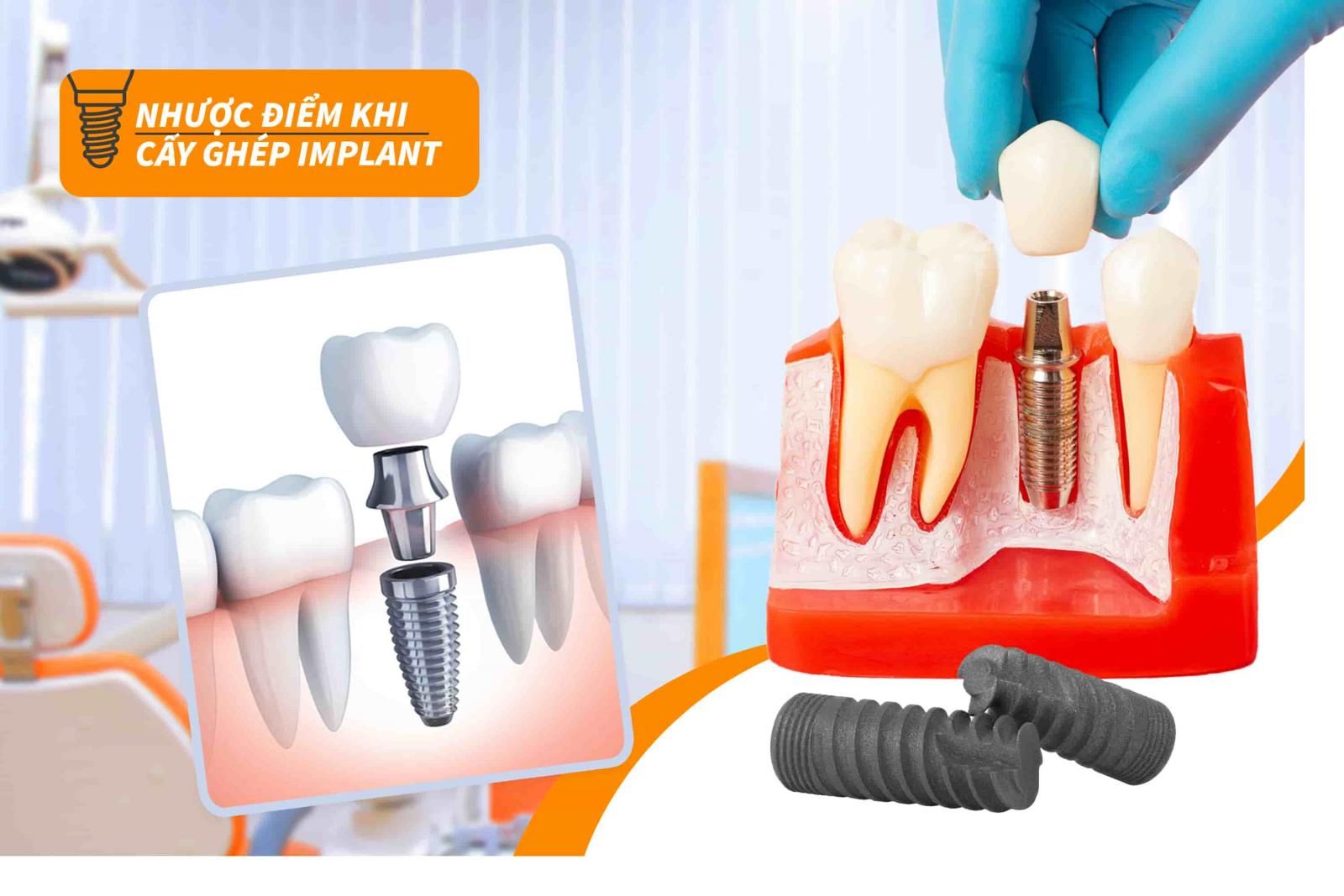 Ưu điểm của trồng răng Implant