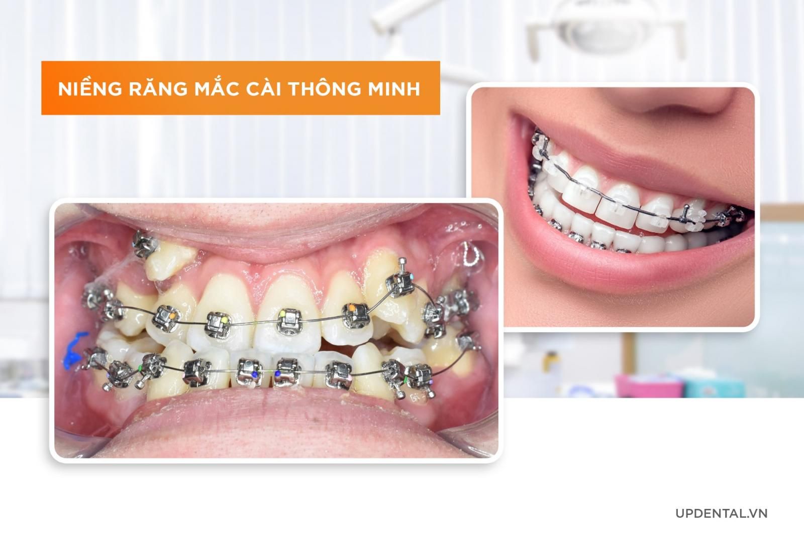 2 phương pháp niềng răng mắc cài thông minh