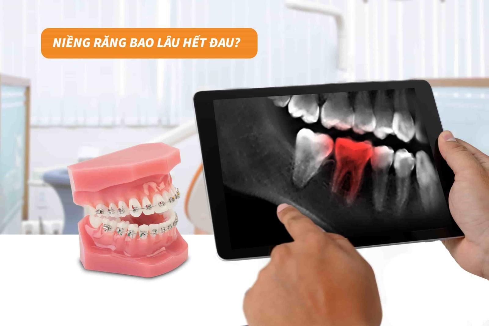 Niềng răng bao lâu thì hết đau