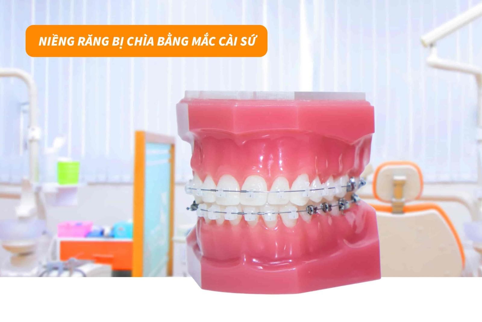 Niềng răng bị chìa bằng mắc cài sứ