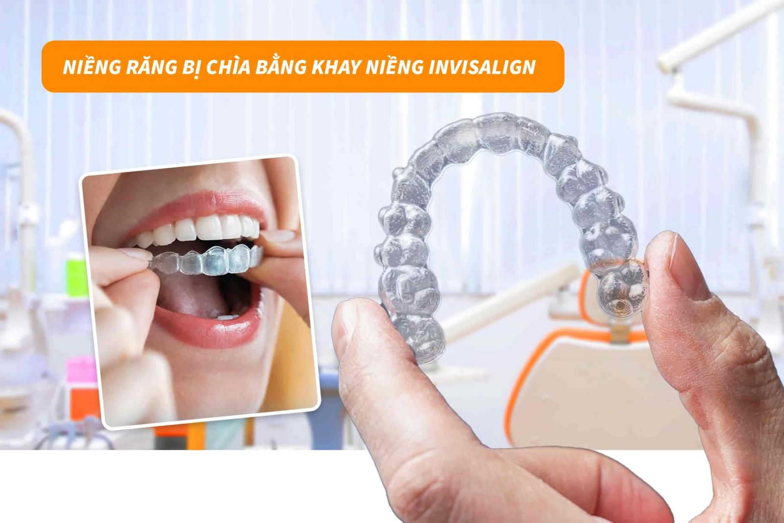 Niềng răng bị chìa bằng khay niềng Invisalign