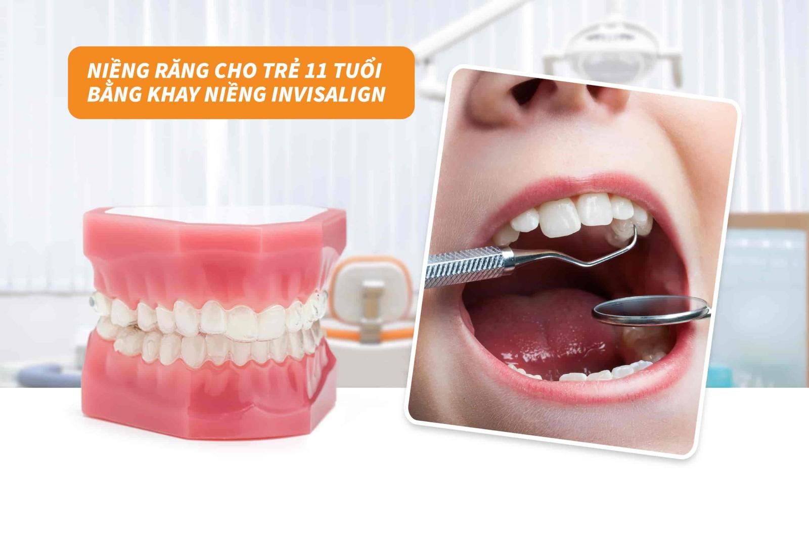 Niềng răng cho trẻ 11 tuổi bằng khay niềng Invisalign