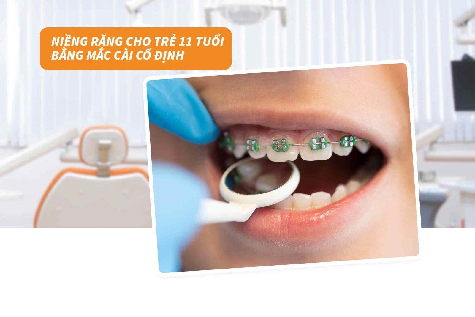 Niềng răng cho trẻ 11 tuổi bằng mắc cài cố định