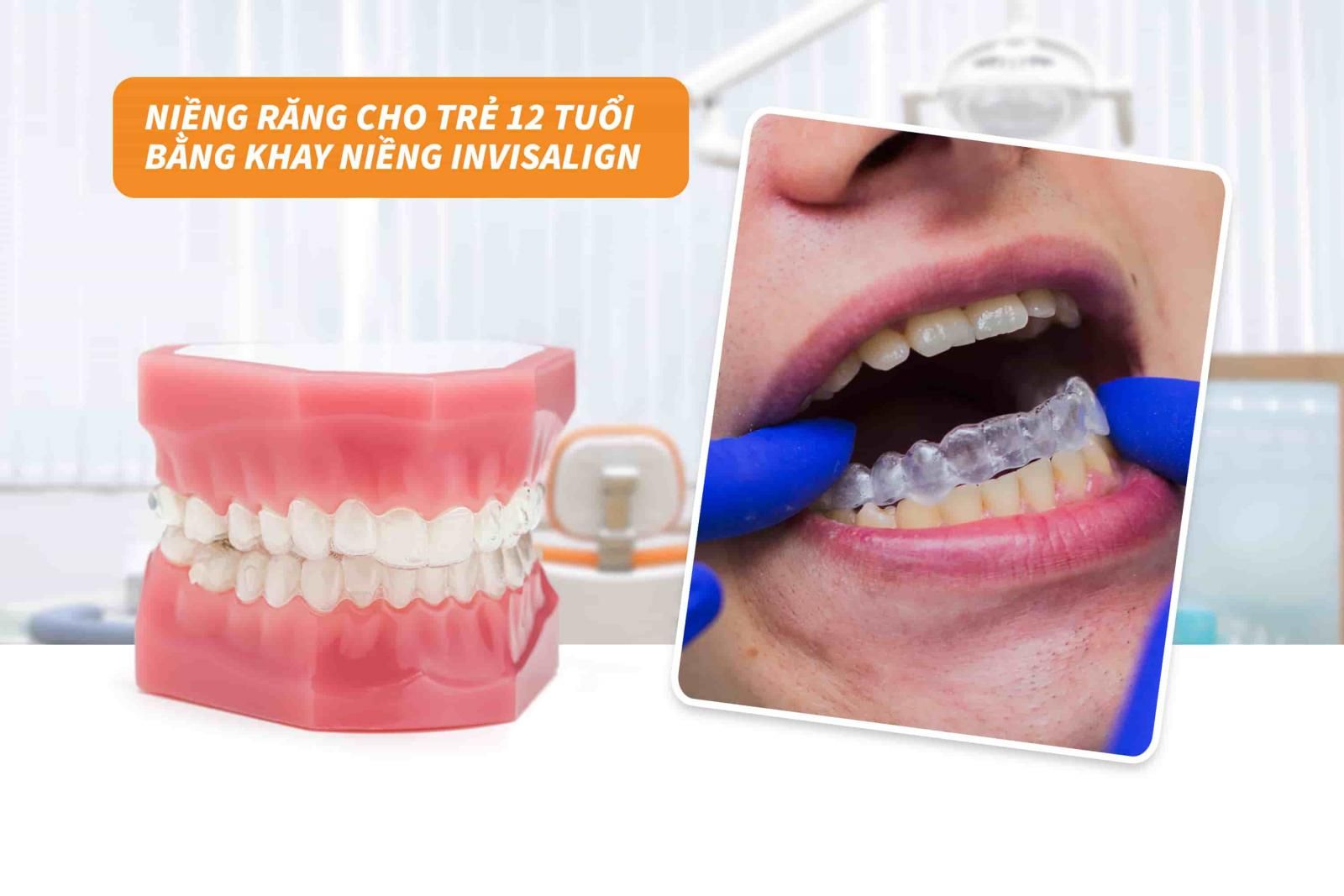 Niềng răng cho trẻ 12 tuổi bằng khay niềng Invisalign