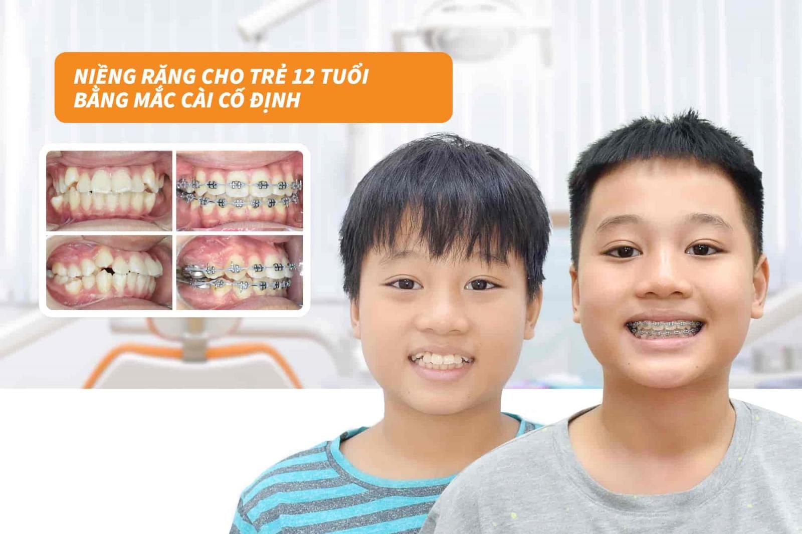 Niềng răng cho trẻ 12 tuổi bằng mắc cài cố định