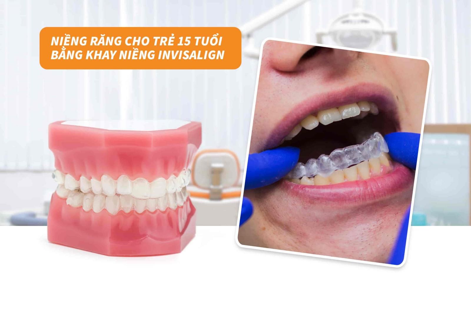 Niềng răng cho trẻ 15 tuổi bằng khay niềng Invisalign