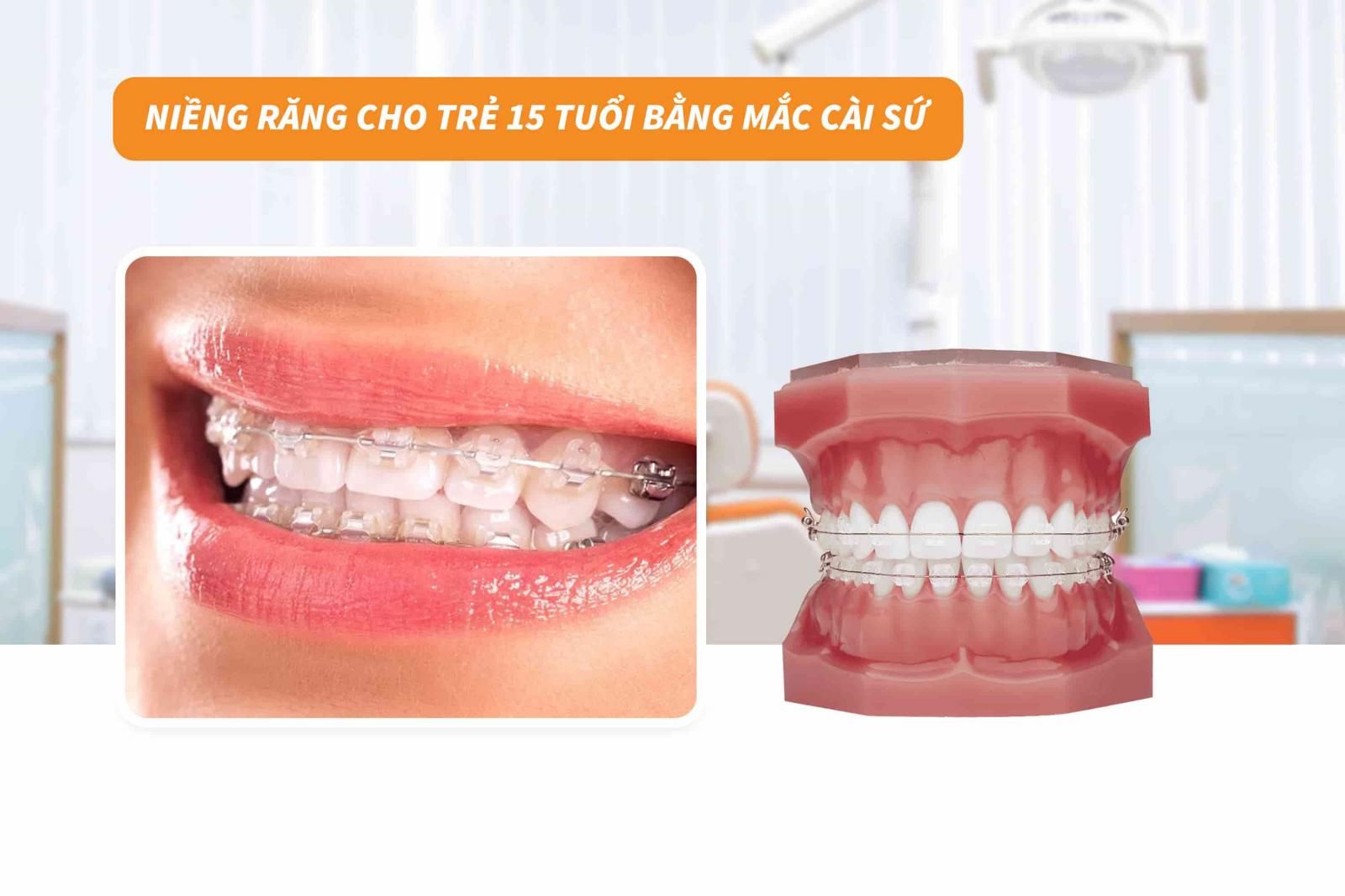 Niềng răng cho trẻ 15 tuổi bằng mắc cài sứ