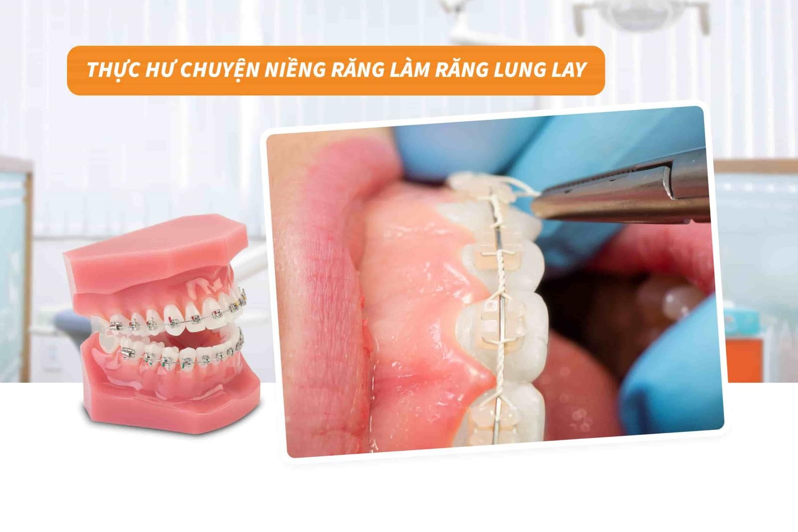 Thực hư chuyện niềng răng làm răng lung lay