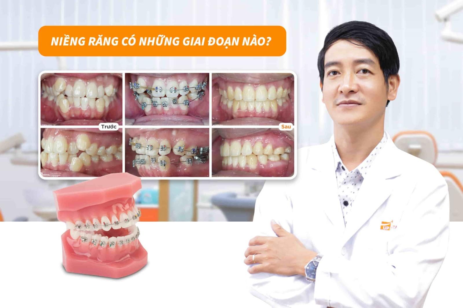 Niềng răng có những giai đoạn nào?