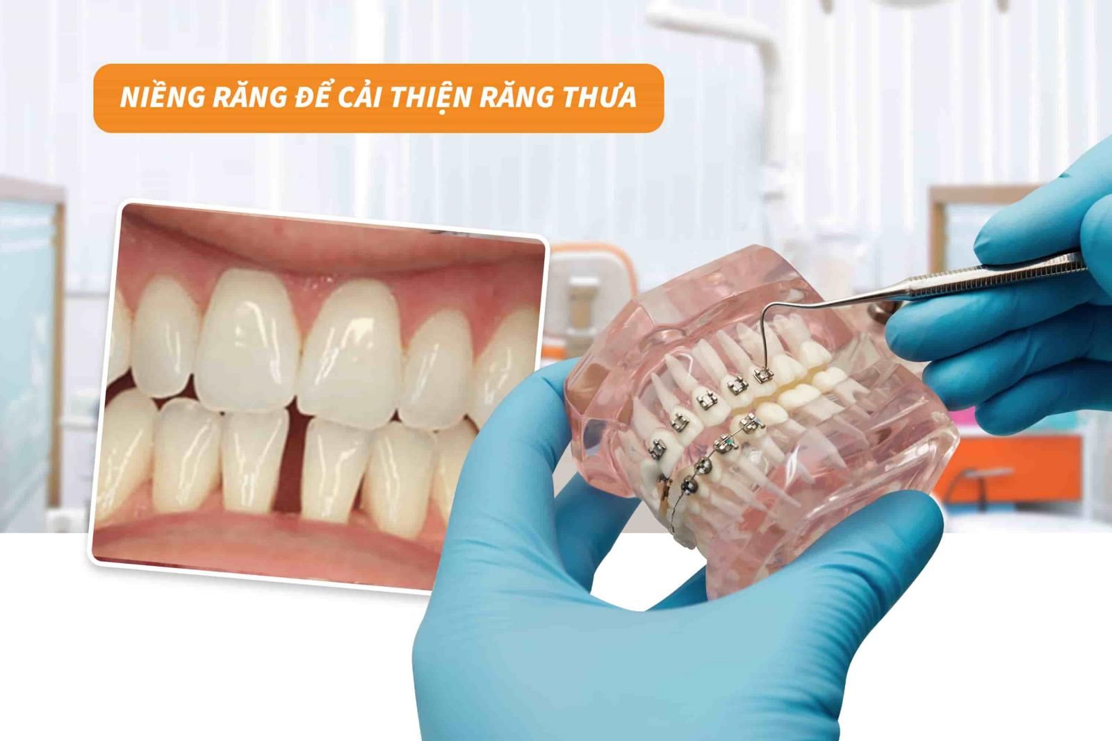 Niềng răng để cải thiện thưa