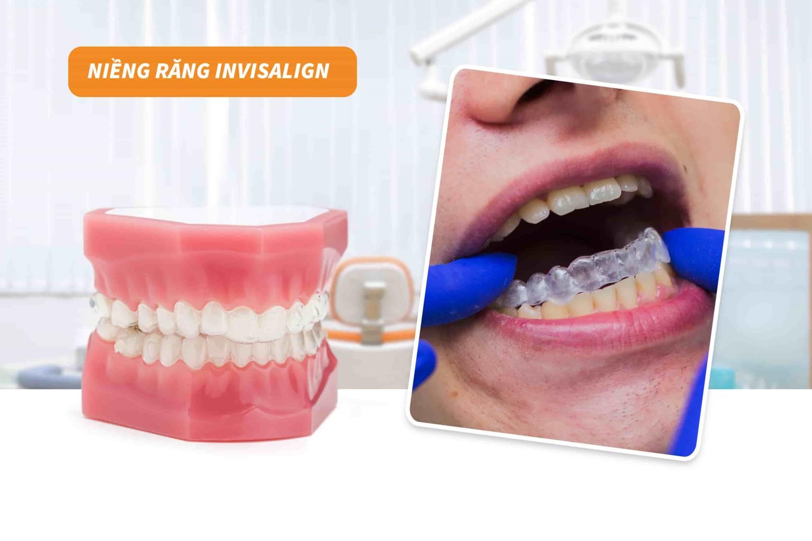 Niềng răng Invisalign