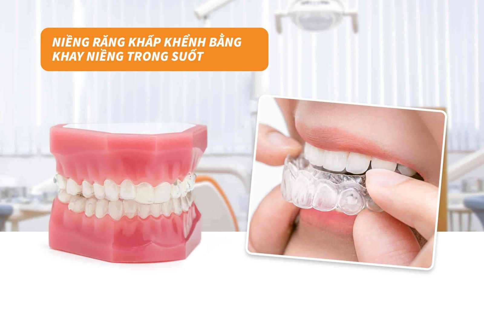 Niềng răng khấp khểnh bằng khay niềng trong suốt