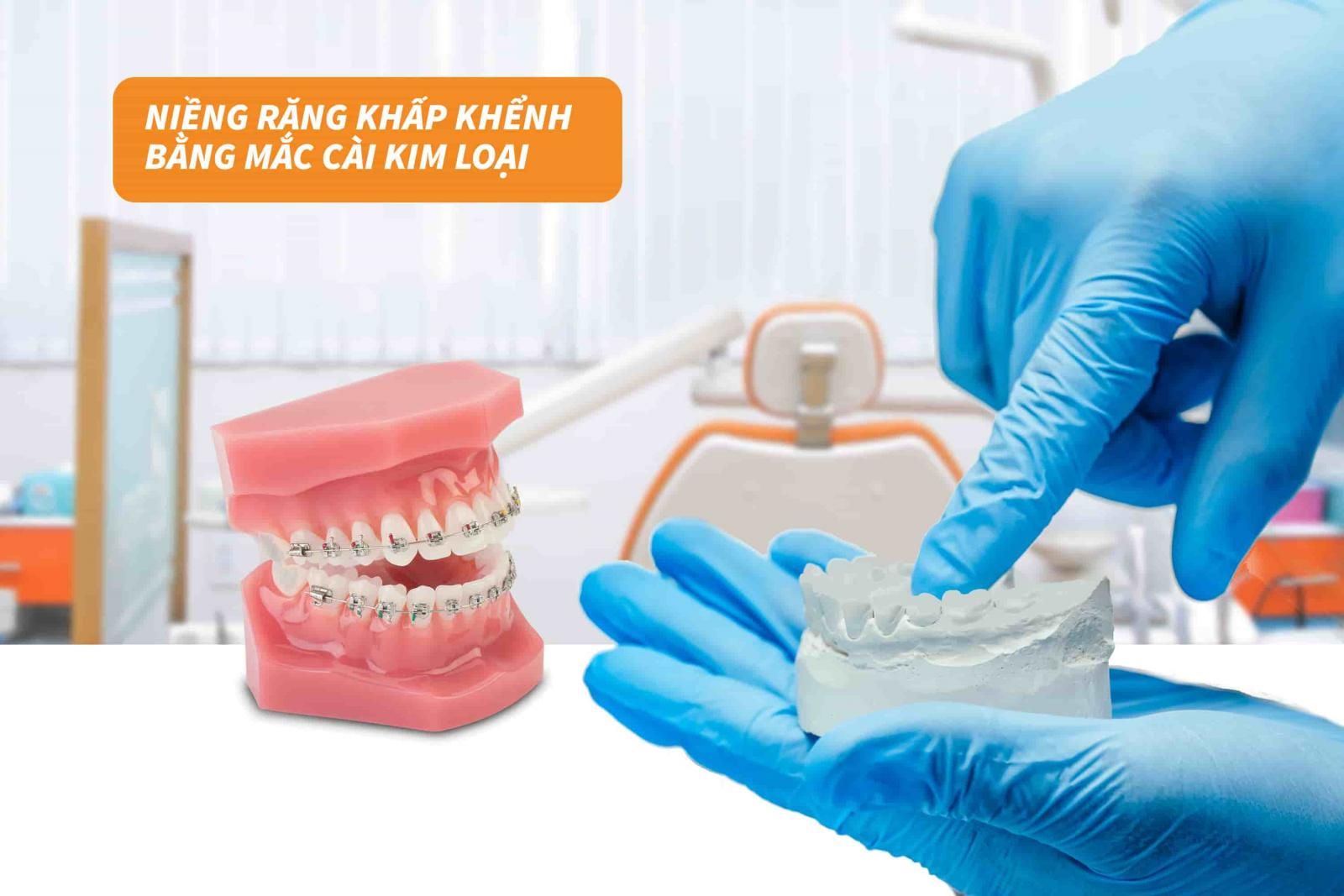 Niềng răng khấp khểnh bằng mắc cài kim loại