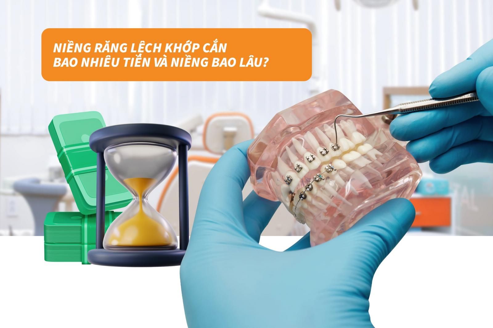 Niềng răng lệch khớp cắn bao nhiêu tiền và niềng bao lâu?