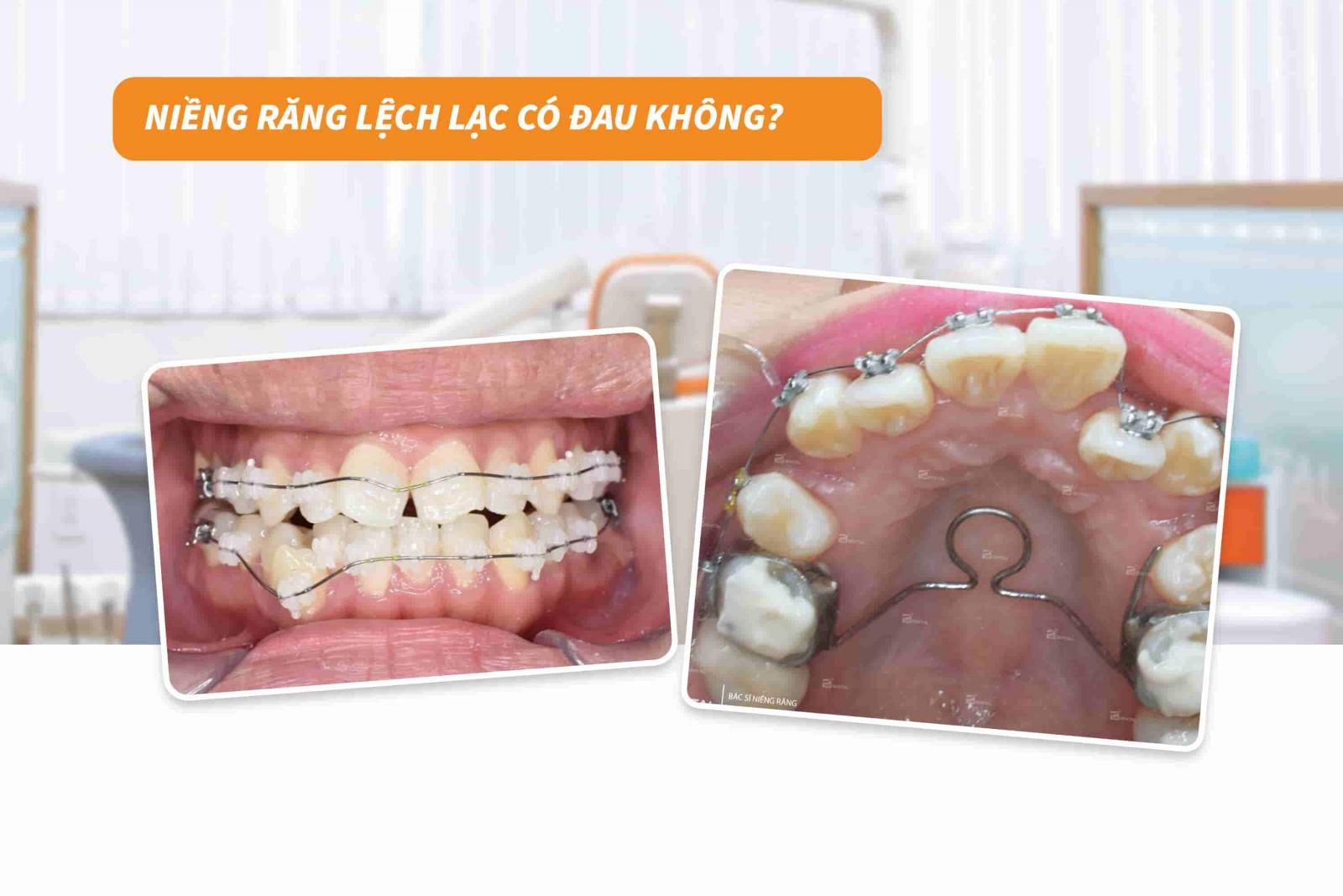 Niềng răng lệch lạc có đau không