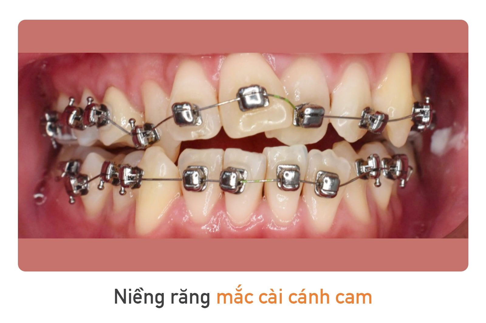 Niềng răng mắc cài cánh cam