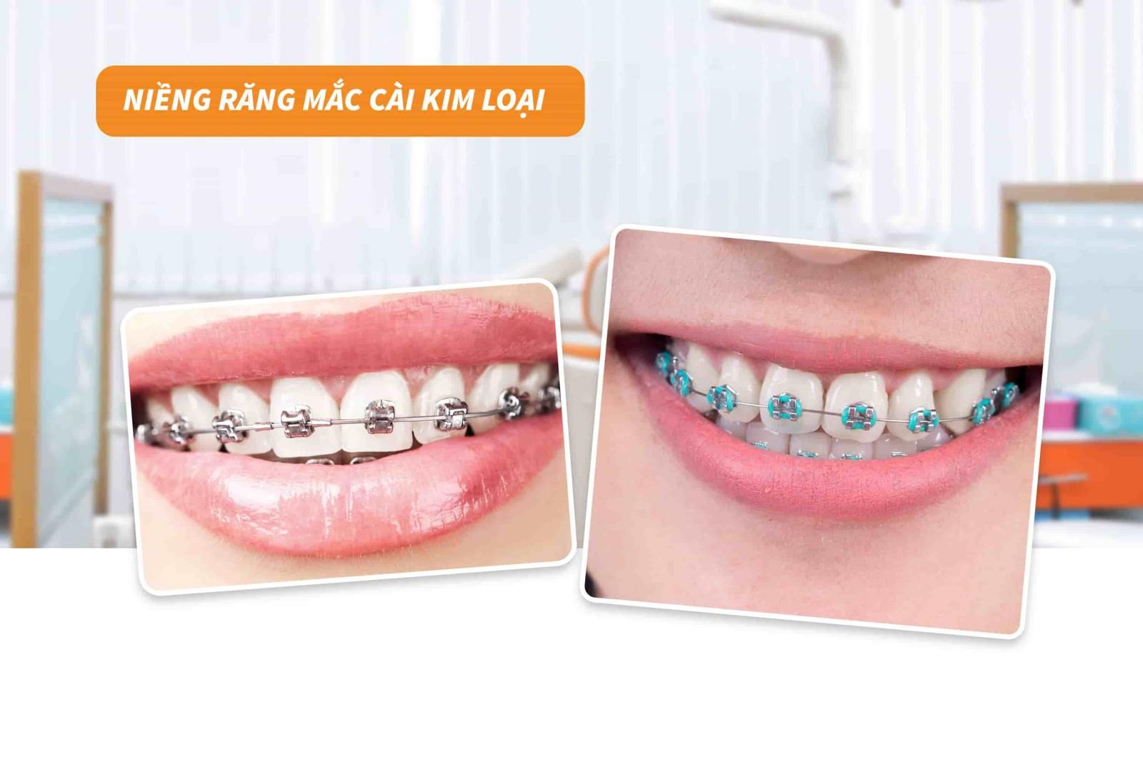 Niềng răng mắc cài kim loại