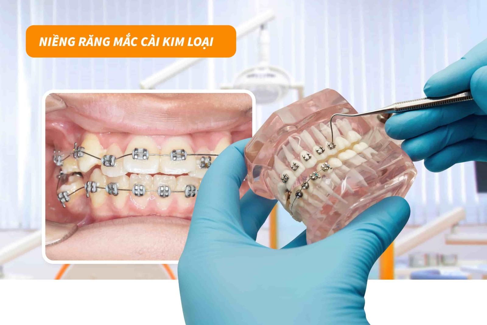 Niềng răng mắc cài kim loại