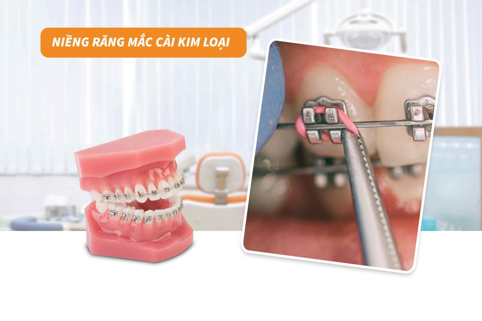 Niềng răng mắc cài kim loại