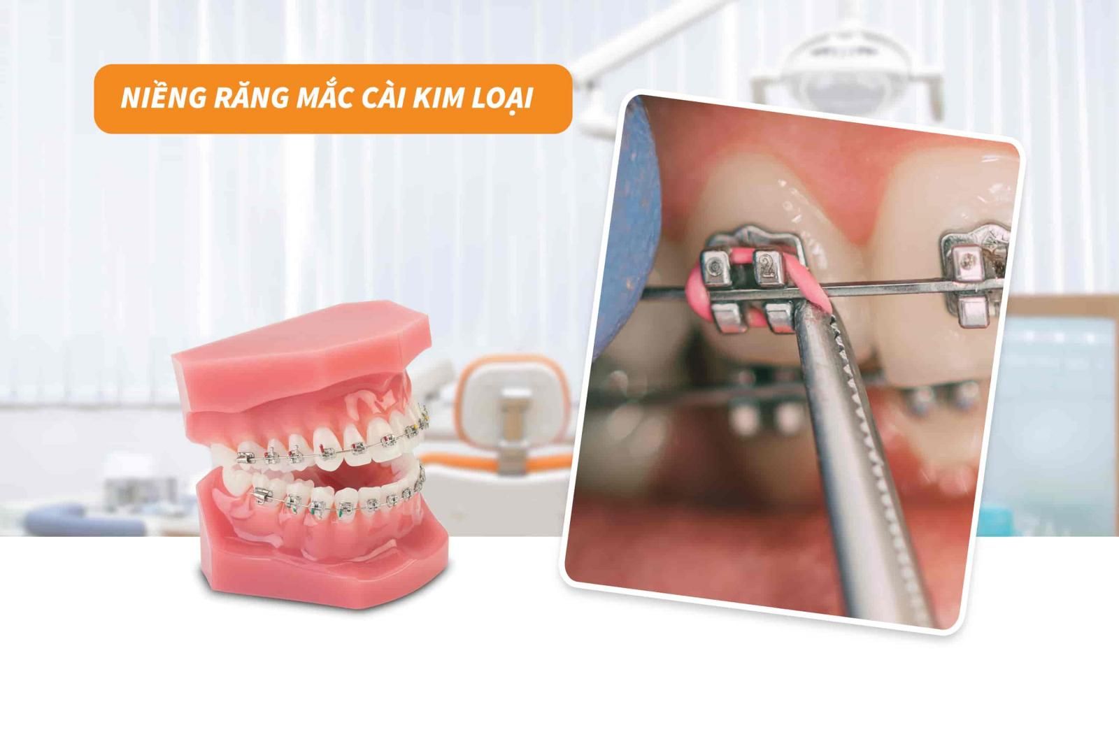 Thời gian và chi phí niềng răng ở tuổi 35