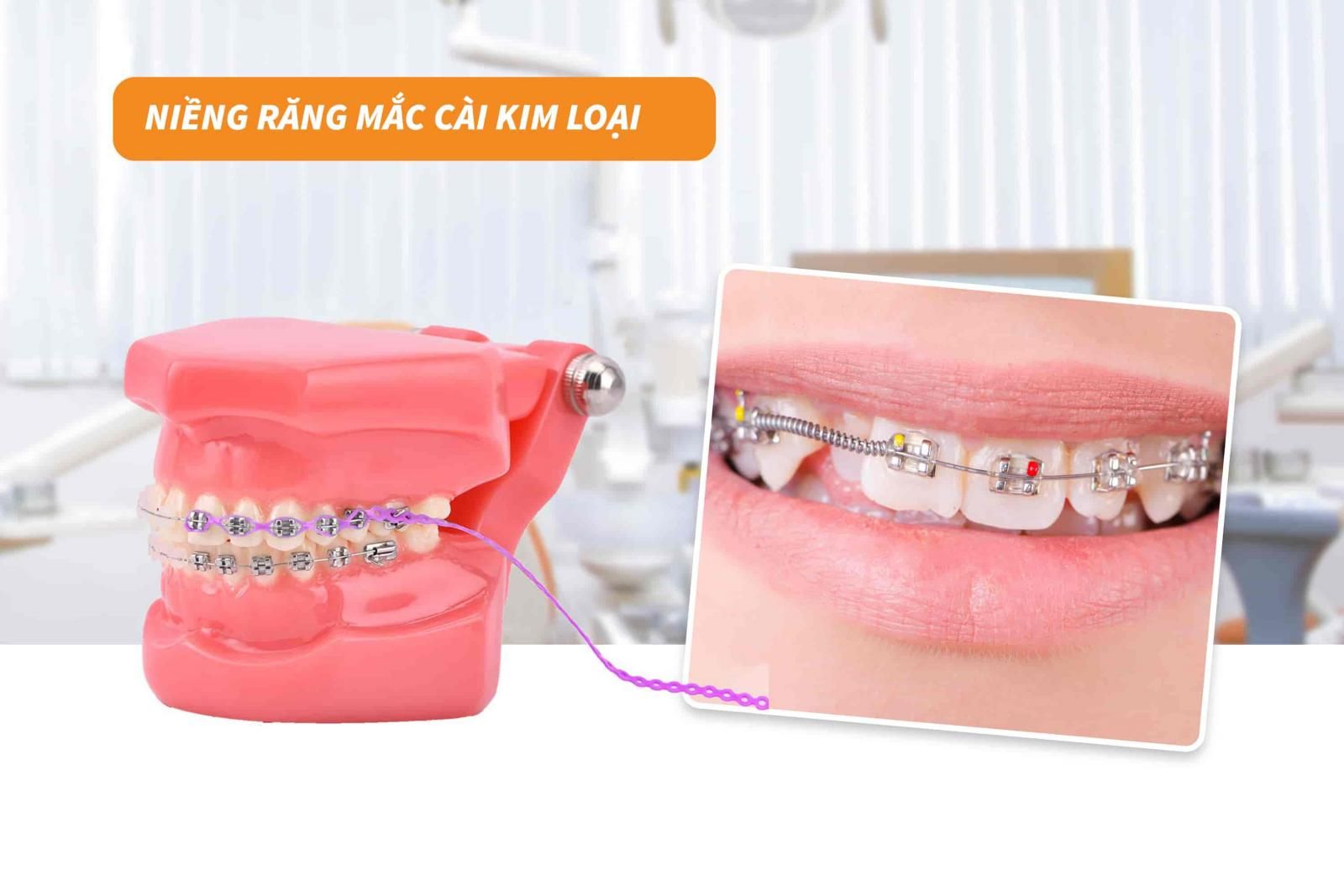 Niềng răng mắc cài kim loại