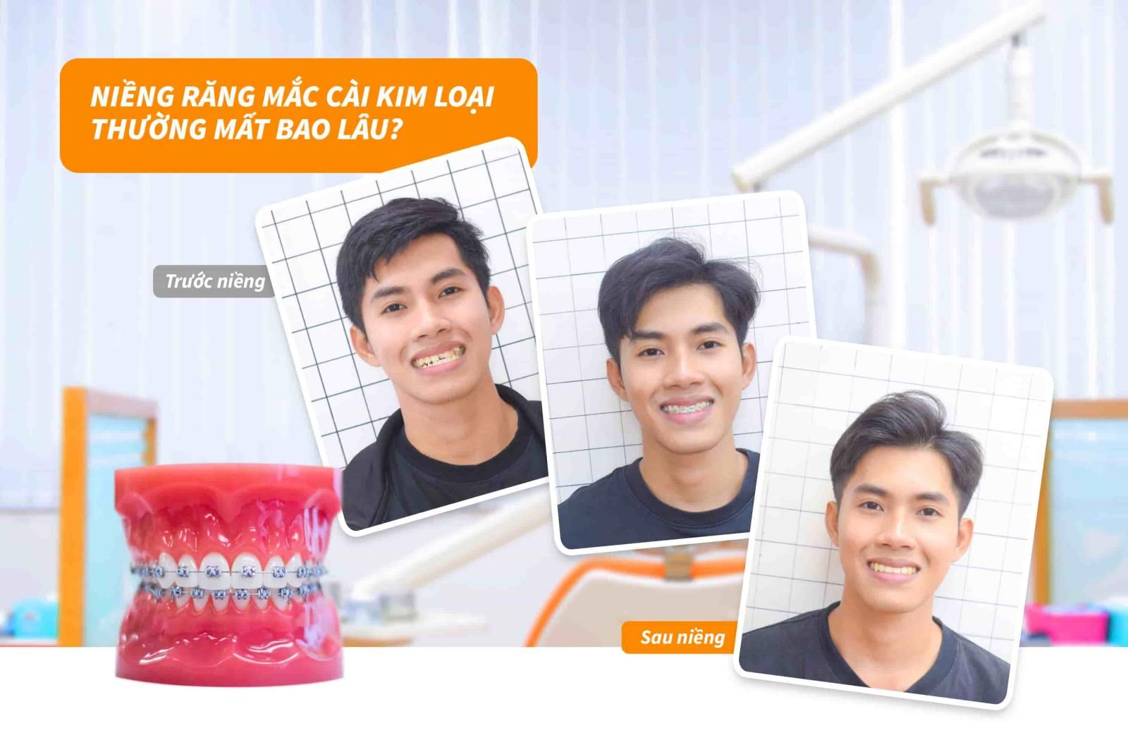 Niềng răng mắc cài kim loại thường mất bao lâu