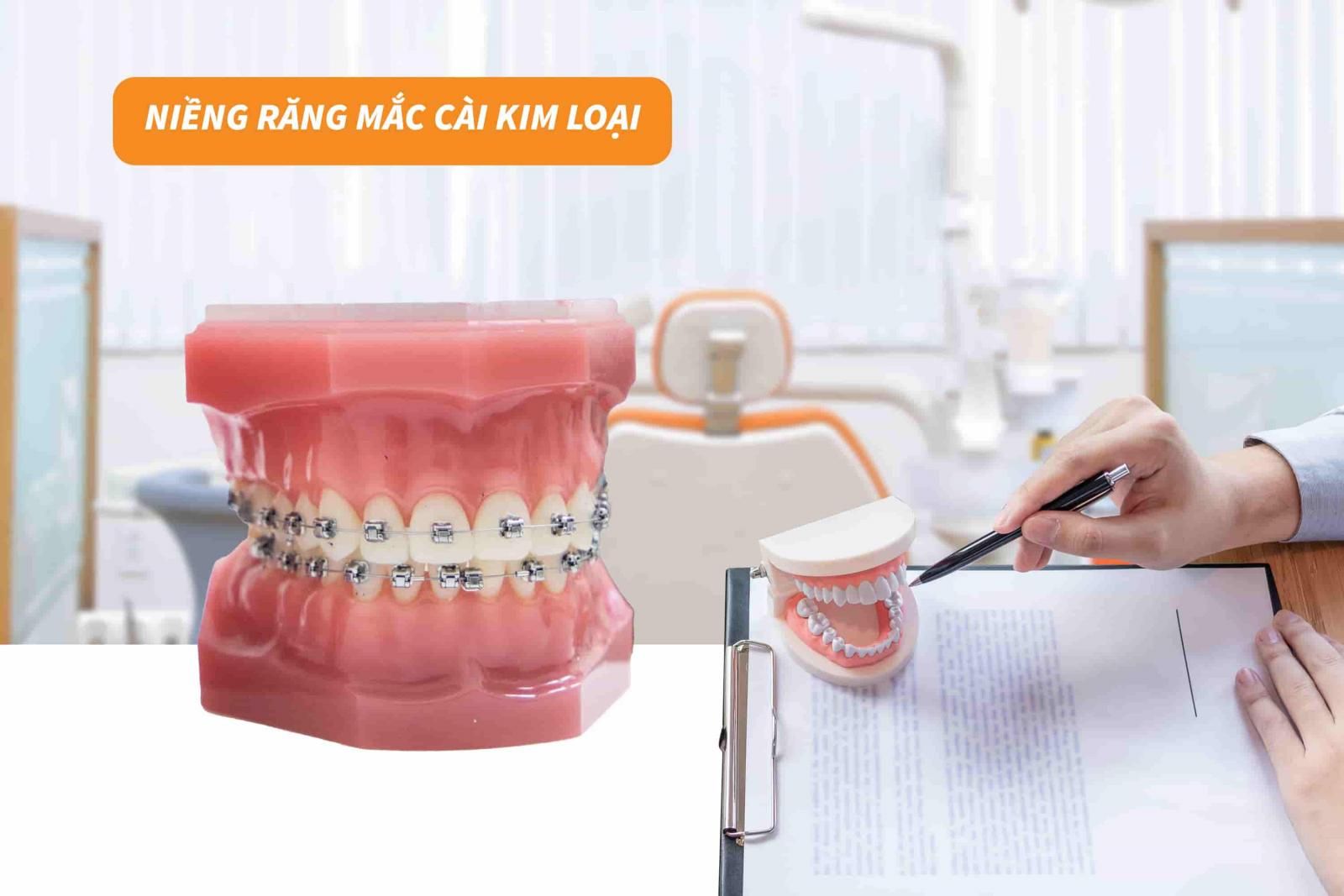 Niềng răng mắc cài kim loại