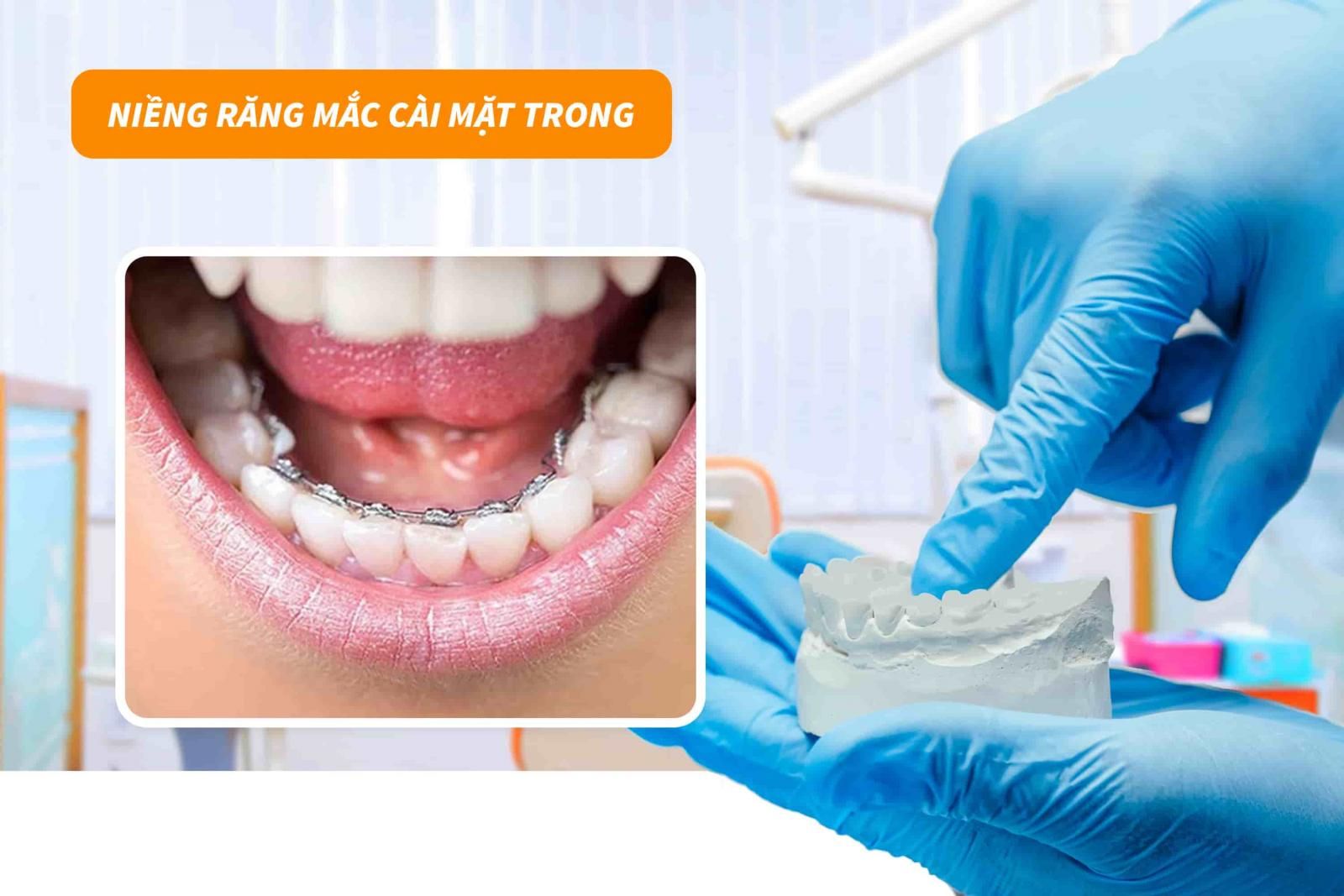 Niềng răng mắc cài mặt trong