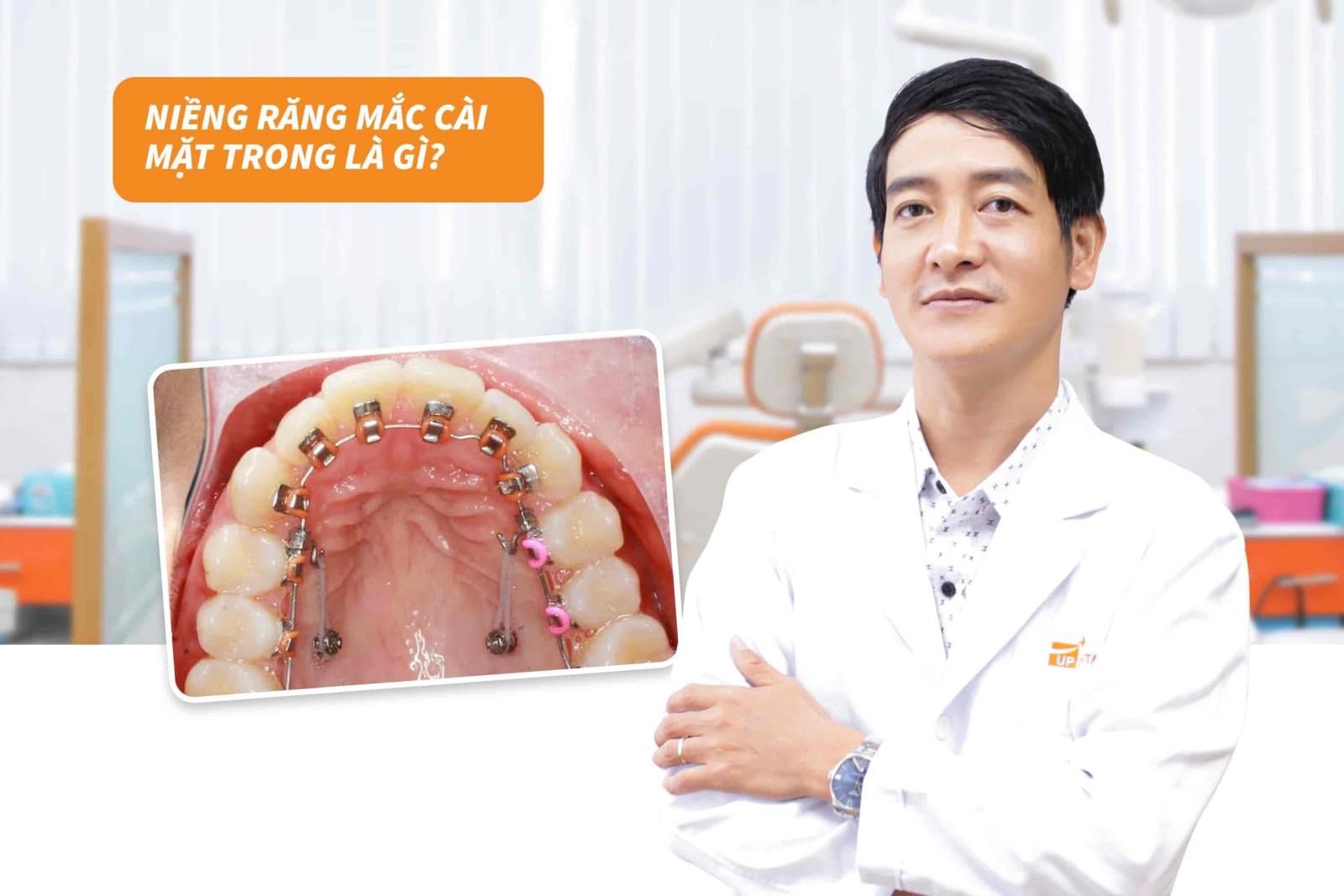 Niềng răng mắc cài mặt trong là gì?