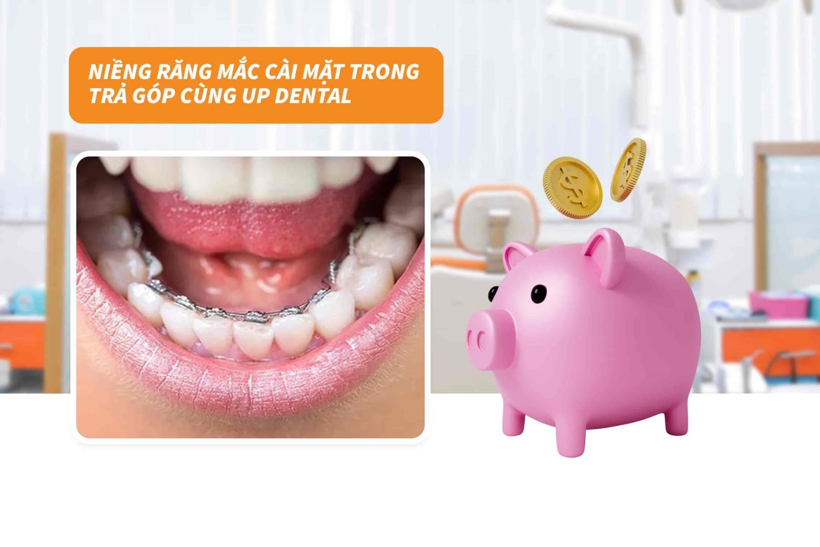 Niềng răng mắc cài mặt trong trả góp cùng Up Dental