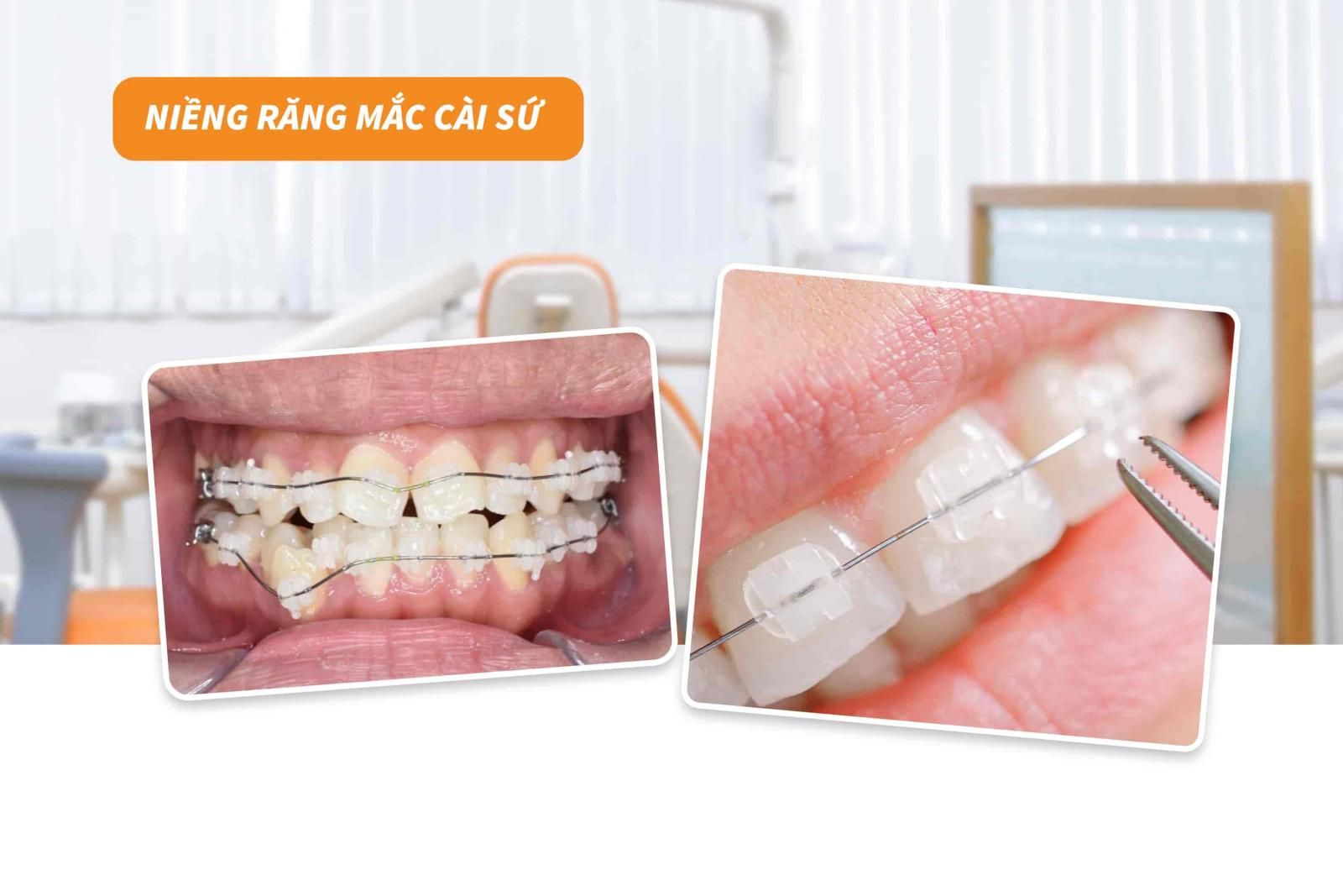 Niềng răng mắc cài sứ