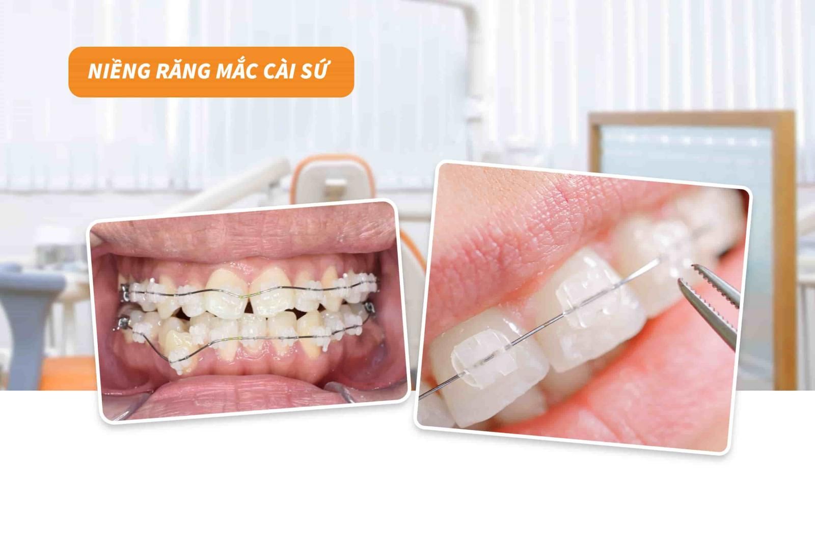 Niềng răng mắc cài sứ