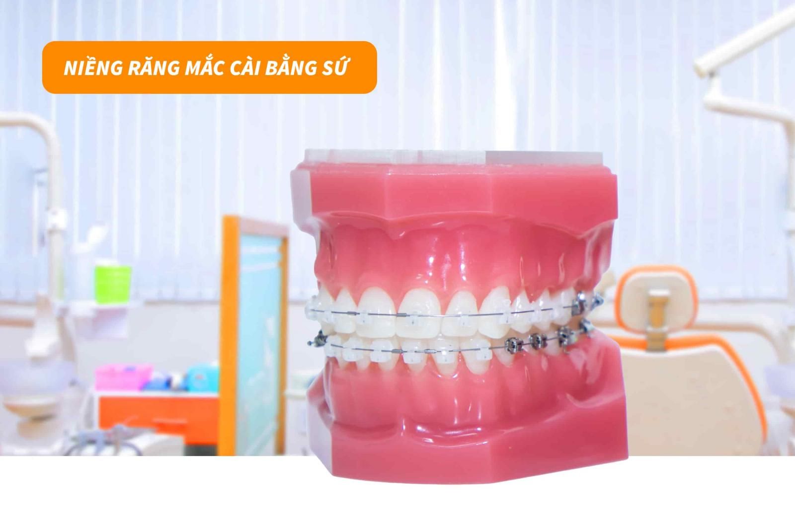 Niềng răng mắc cài sứ