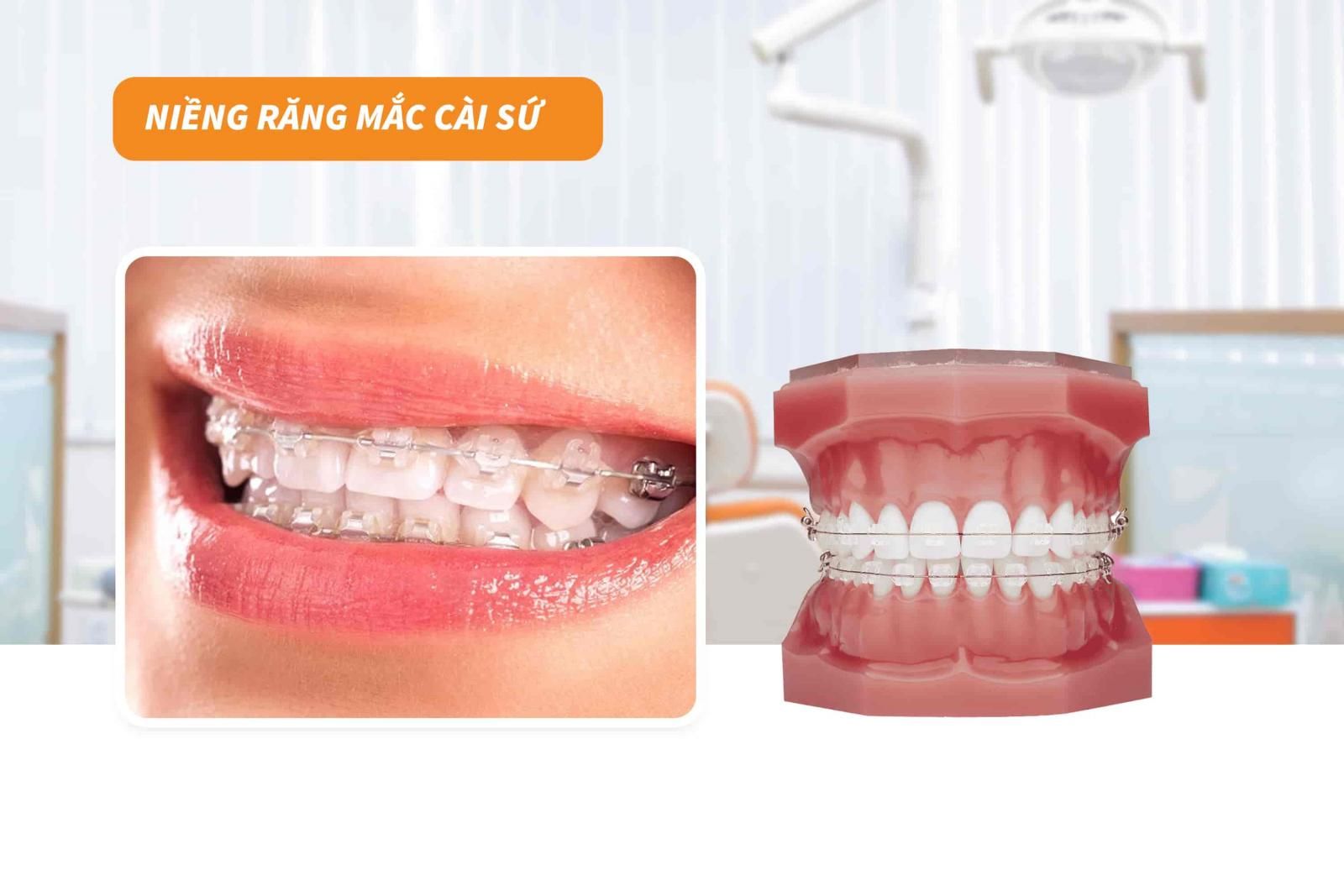 Niềng răng mắc cài sứ