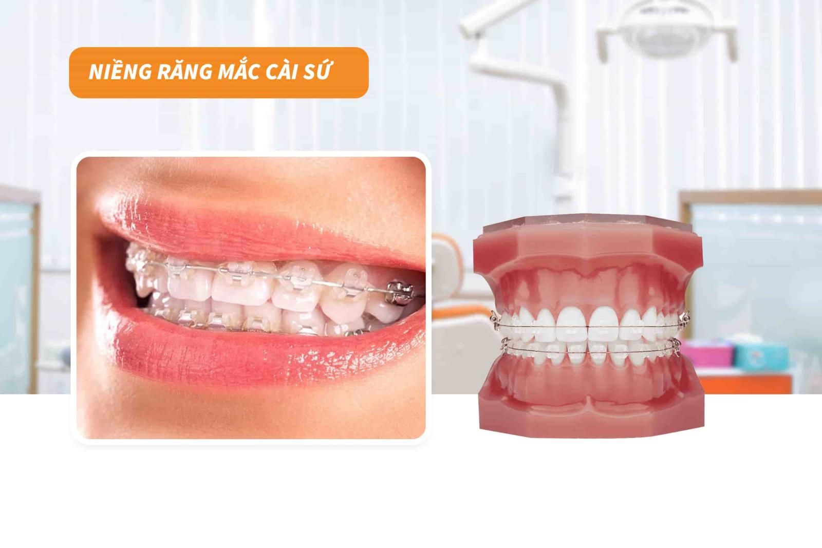 Niềng răng mắc cài sứ