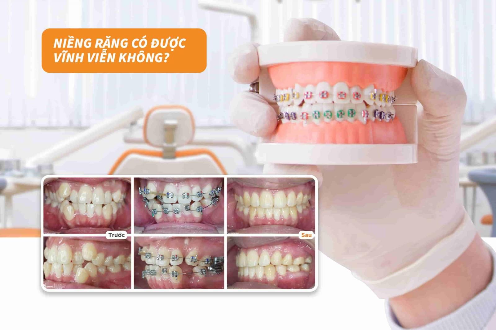 Niềng răng có được vĩnh viễn không?