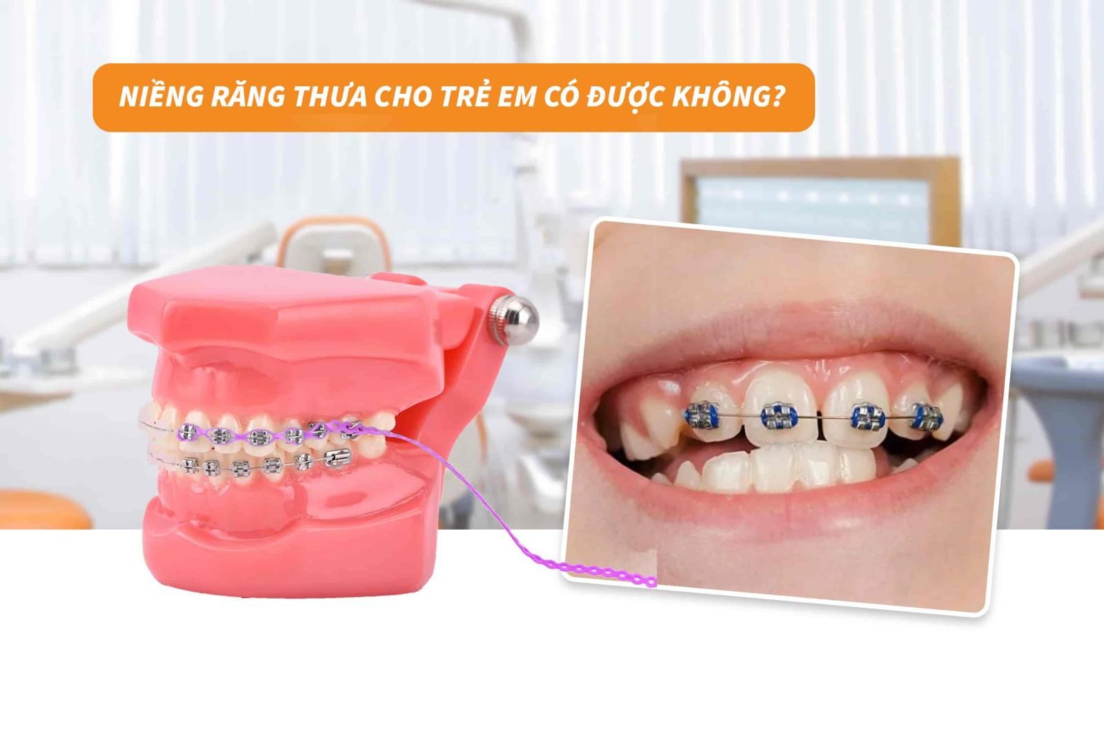 Niềng răng thưa cho trẻ em có được không?