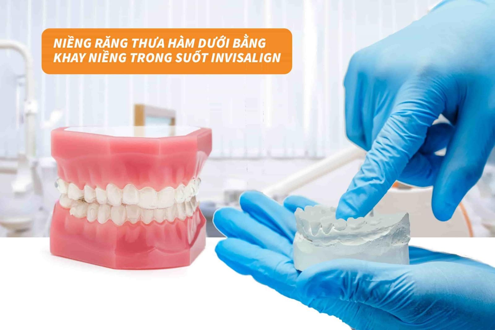 Niềng răng thưa hàm dưới bằng khay niềng trong suốt Invisalign