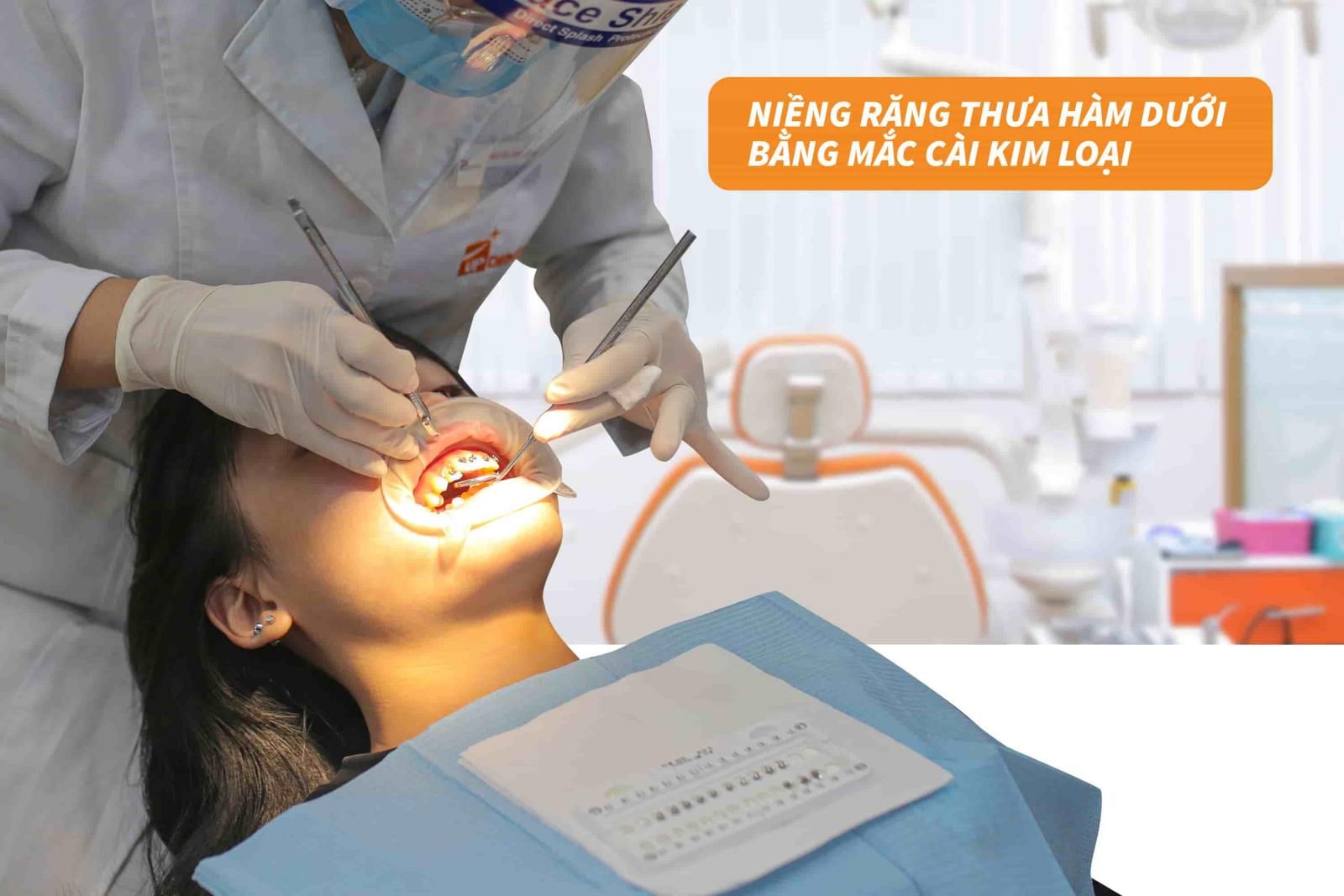 Niềng răng thưa hàm dưới bằng mắc cài kim loại