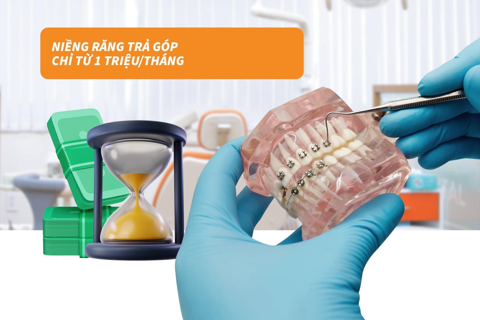 Niềng răng trả góp chỉ từ 1 triệutháng