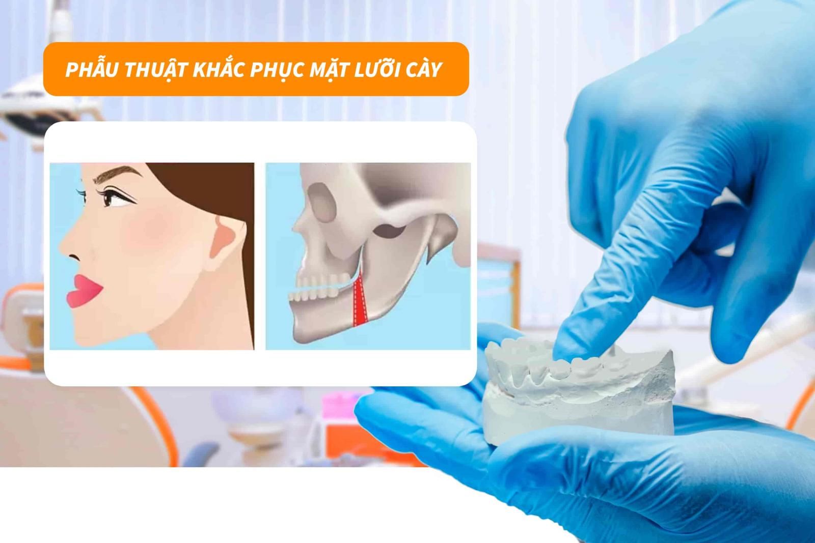 Phẫu thuật khắc phục mặt lưỡi cày