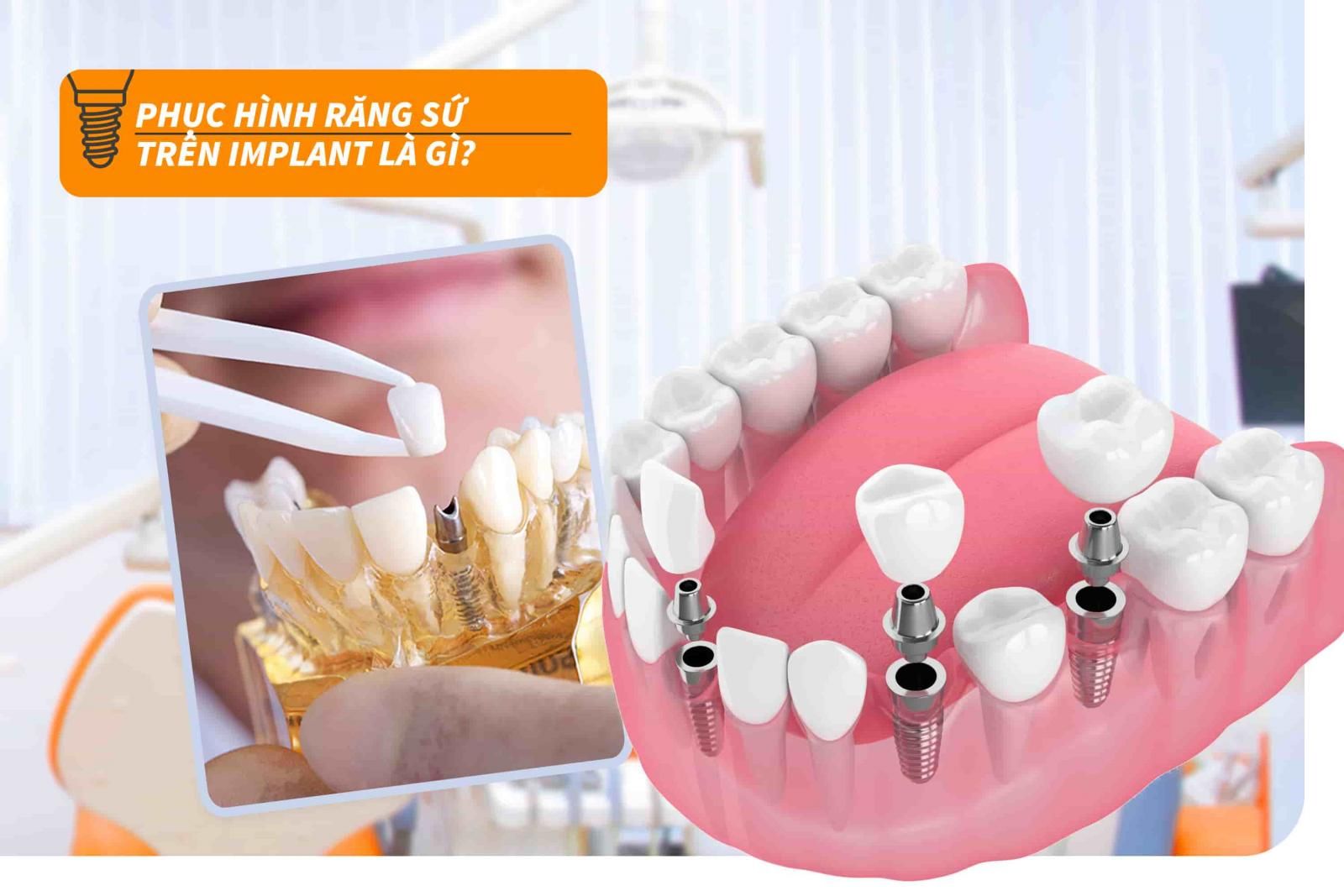 Phục hình sứ trên răng Implant là gì?