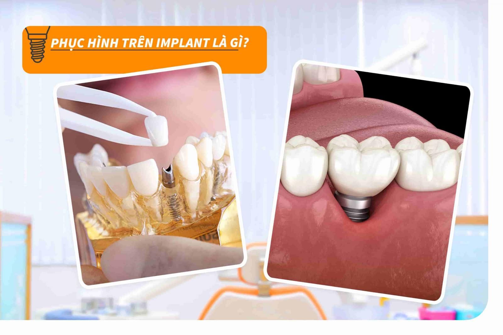 Phục hình trên Implant là gì?