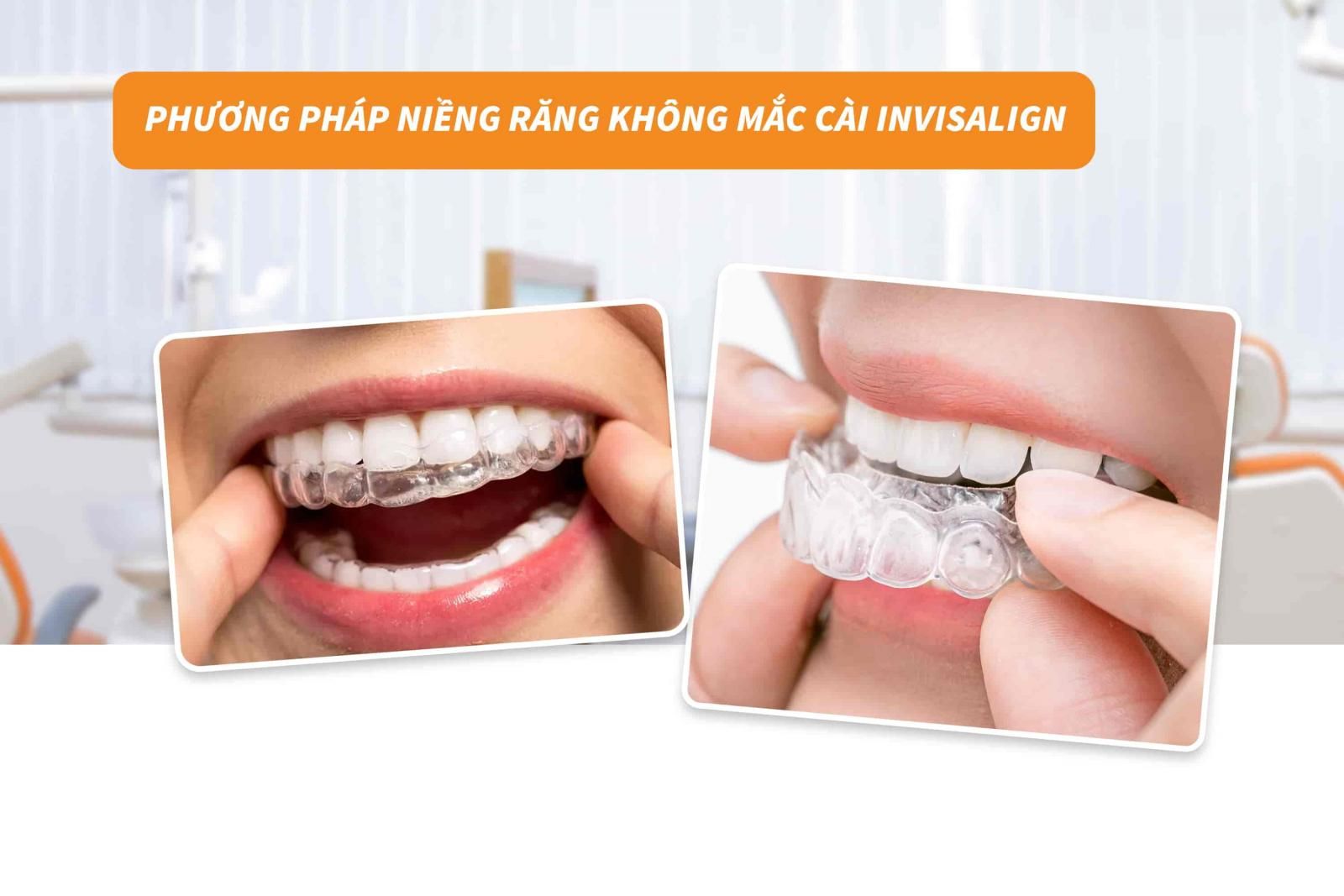 Phương pháp niềng răng không mắc cài Invisalign