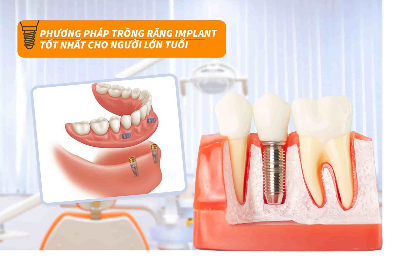 Phương pháp trồng răng Implant cho người lớn tuổi tốt nhất