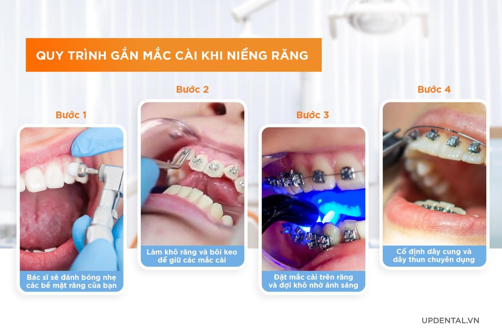 quy trình gắn mắc cài khi niềng răng