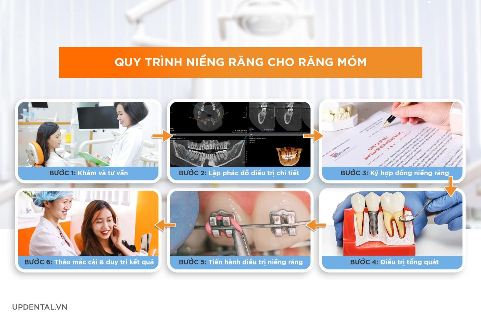 quy trình niềng răng móm