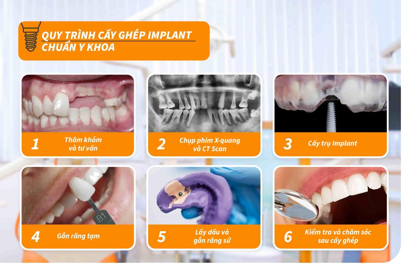 Quy trình cấy ghép Implant chuẩn Y khoa